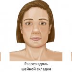 Incision options for mandibular resection