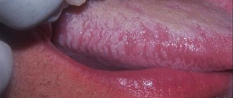 HIV oral infection