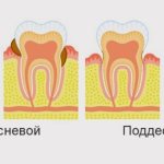 Type of tartar