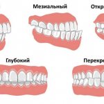 types of malocclusion