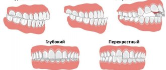 types of malocclusion