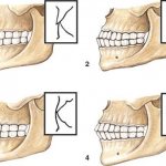 Types of human bite