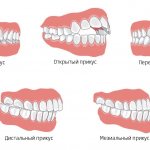 Types of bites