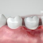 Gum inflammation after implant placement