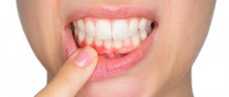 Tooth root inflammation: causes, symptoms and treatment