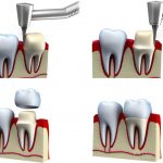 Restoration of the tooth crown