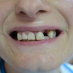 temporary dentures indications