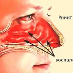 Posterior rhinitis