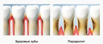 Healthy teeth and periodontitis in pictures