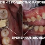 Tooth 4.6 destroyed by caries