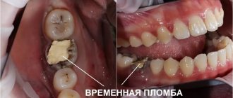 Tooth 4.6 destroyed by caries