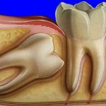 wisdom tooth