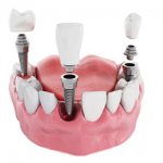 Dental crowns - Dentistry Line Smiles